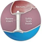 Load image in gallery viewer, Fecal Incontinence Plug Renew
